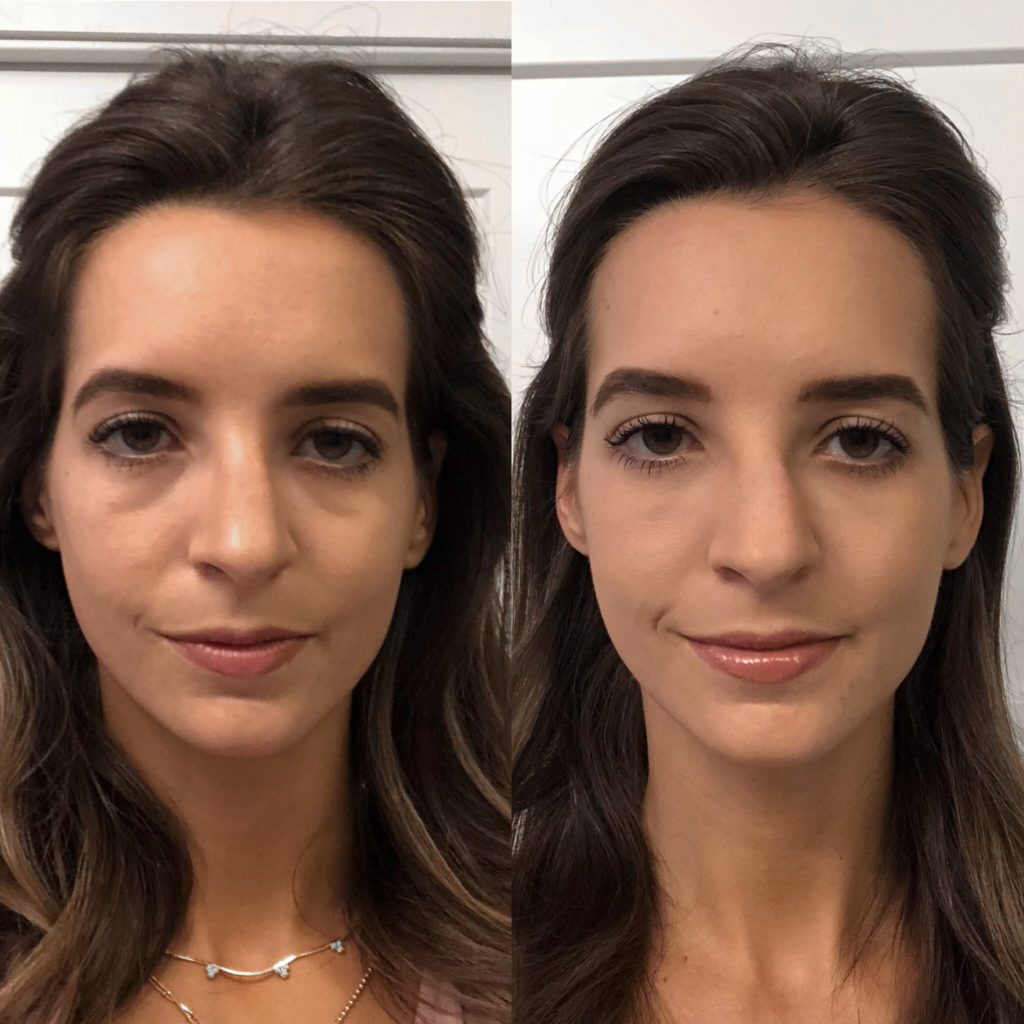 under eye filler before and after