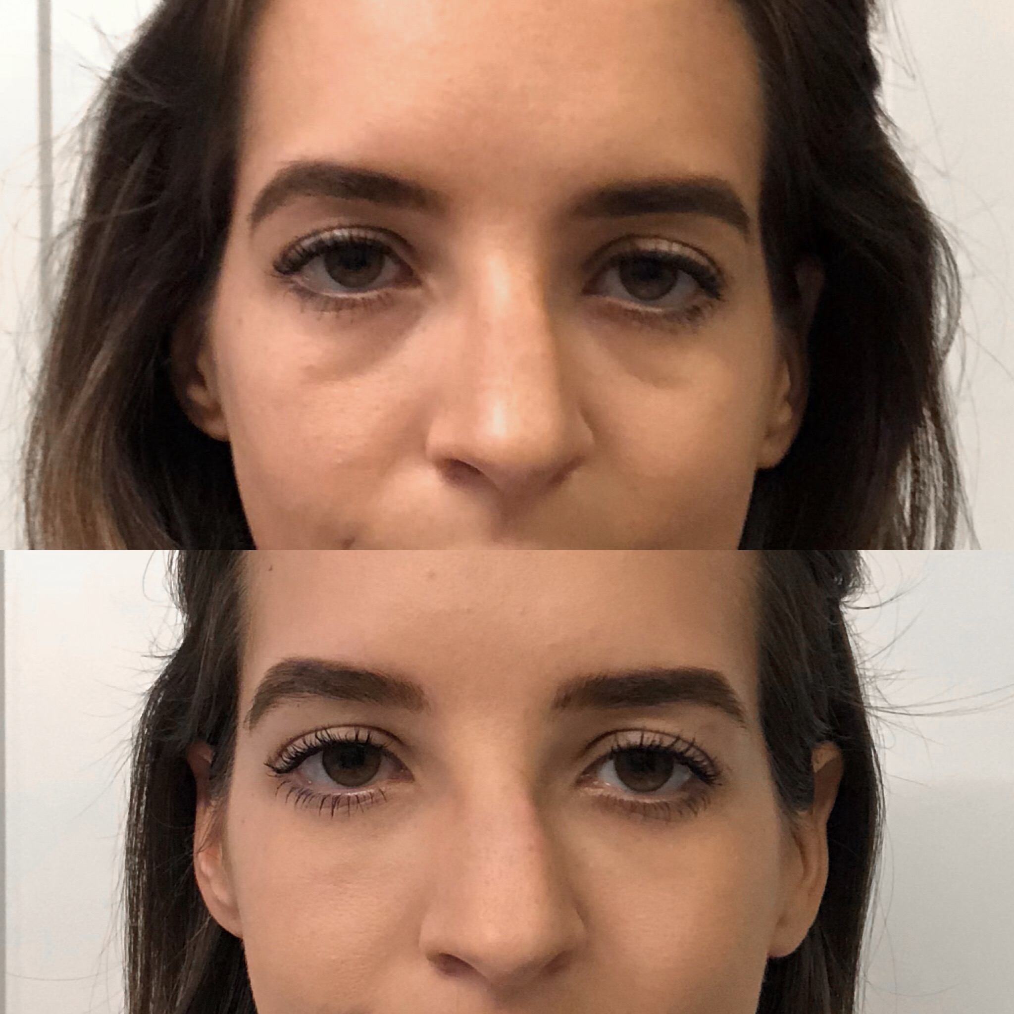 Under Eye Fillers/ Dark Circle Reduction Before and After photos Dallas